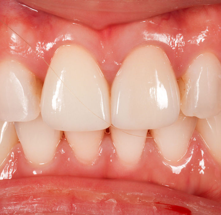 Smile-zone follow-up after indirect veneer for one discolored tooth