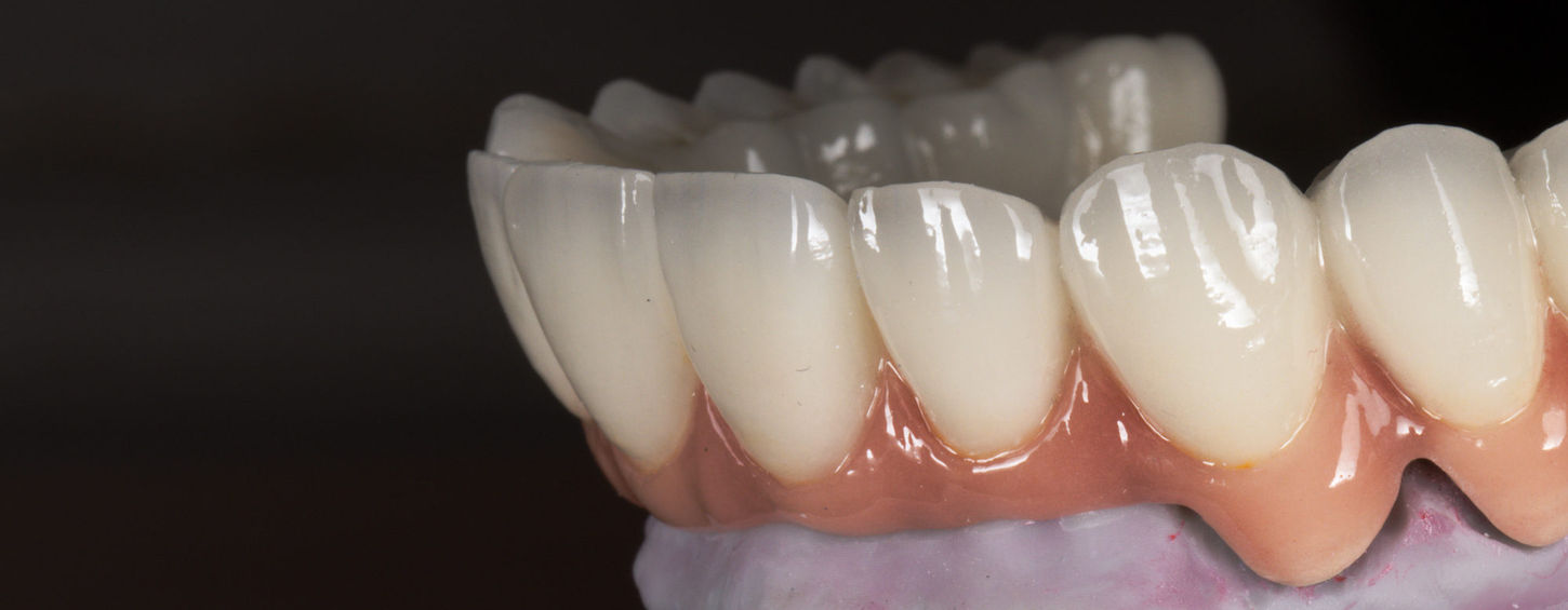 Full mouth implant rehabilitation smile photo after All-on-X style treatment