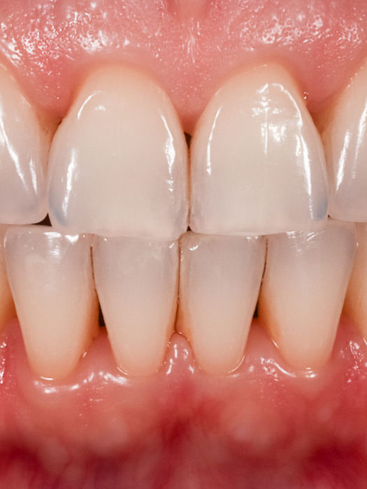 Full mouth bonding for mal-shaped teeth before and after — cosmetic dentistry case at SOL Dental Arts in Maspeth, Queens
