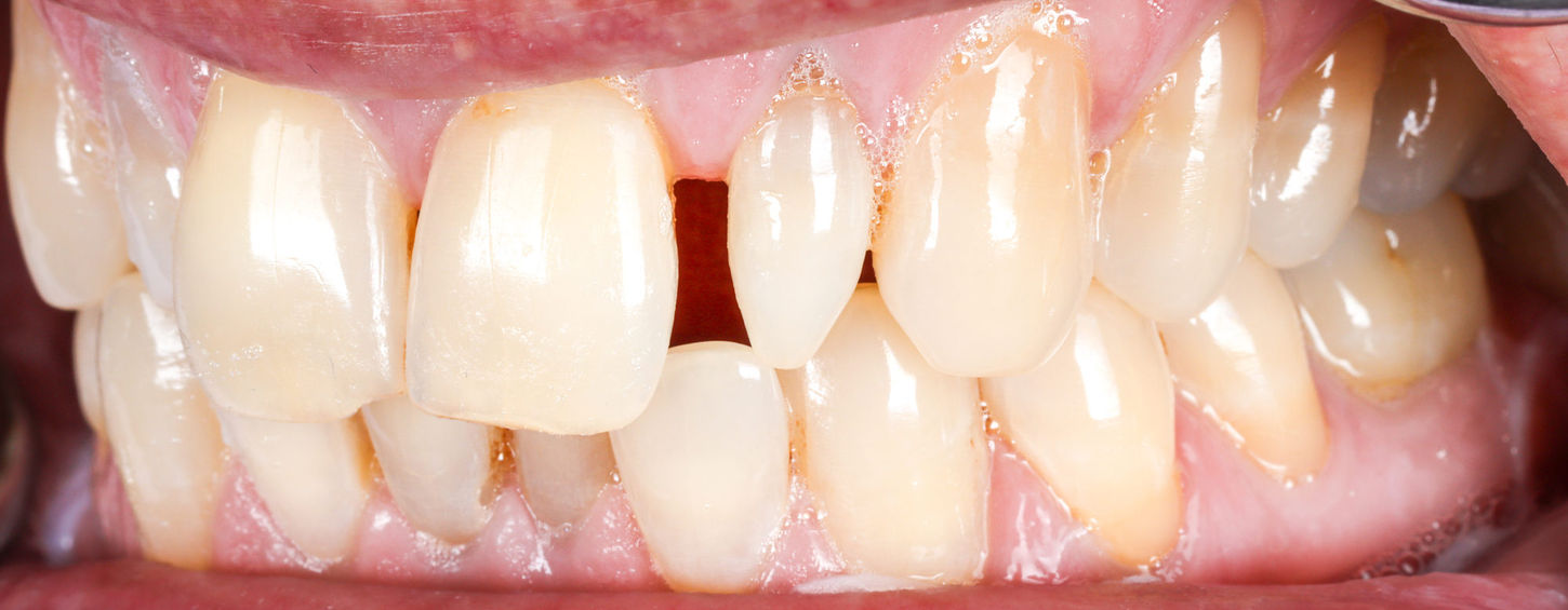 Natural-looking composite veneer result for small lateral incisors in Queens
