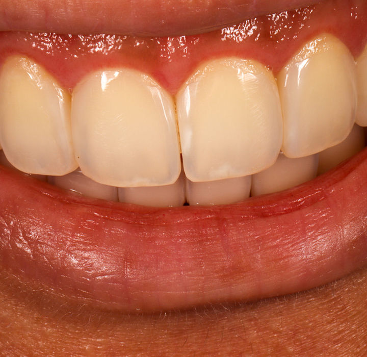 Front tooth contour refinement after Bioclear black triangle closure in Queens