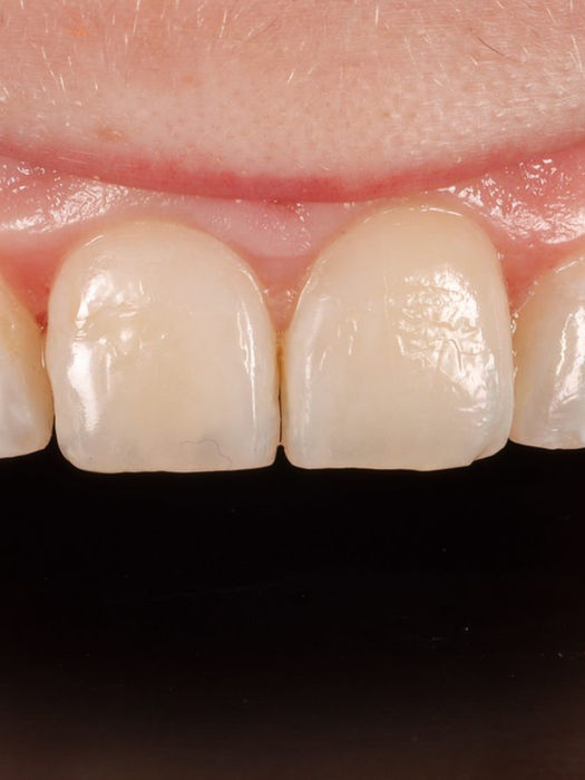 A chipped, discolored upper front tooth blended into an even smile with minimally invasive composite bonding — before and after at SOL Dental Arts, Maspeth, Queens.