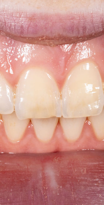 Front teeth after composite bonding veneer color correction