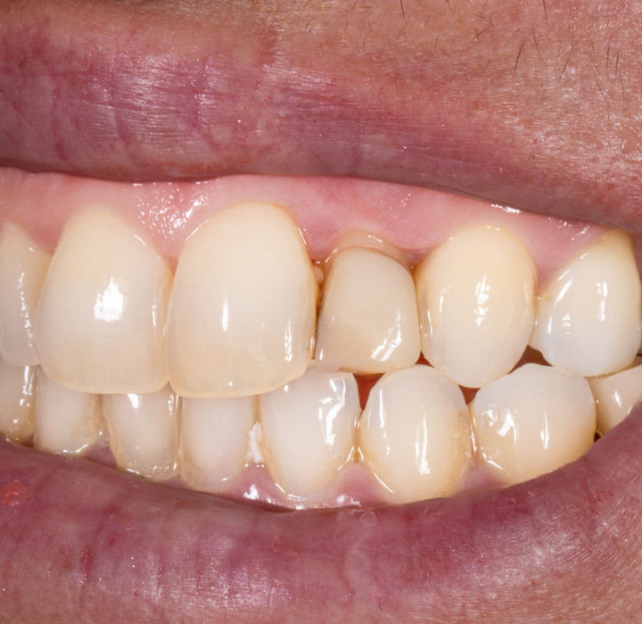 Close-up before replacing worn composite bonding with a composite veneer
