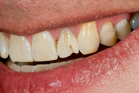 Emergency composite veneer treatment for a damaged front tooth at SOL Dental Arts, Maspeth Queens — case photo 4