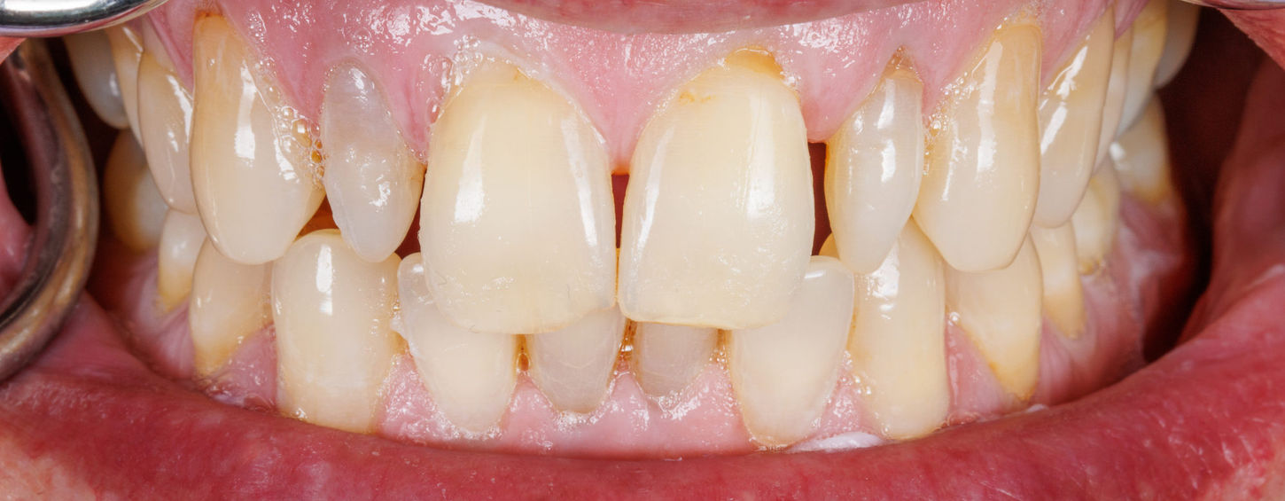 Small lateral incisor case photo before conservative composite veneer treatment