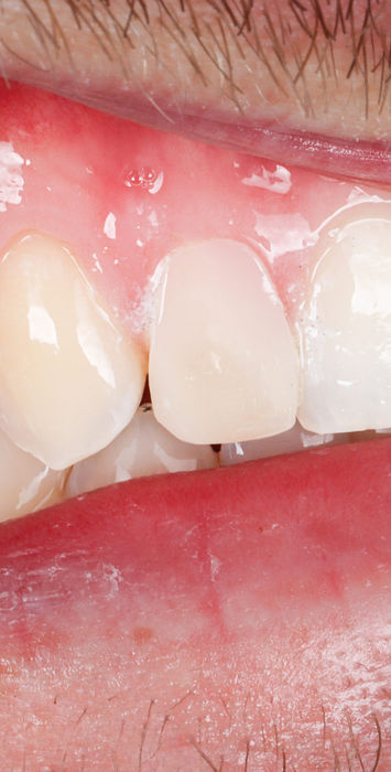 Conservative composite veneer result for small laterals at SOL Dental Arts