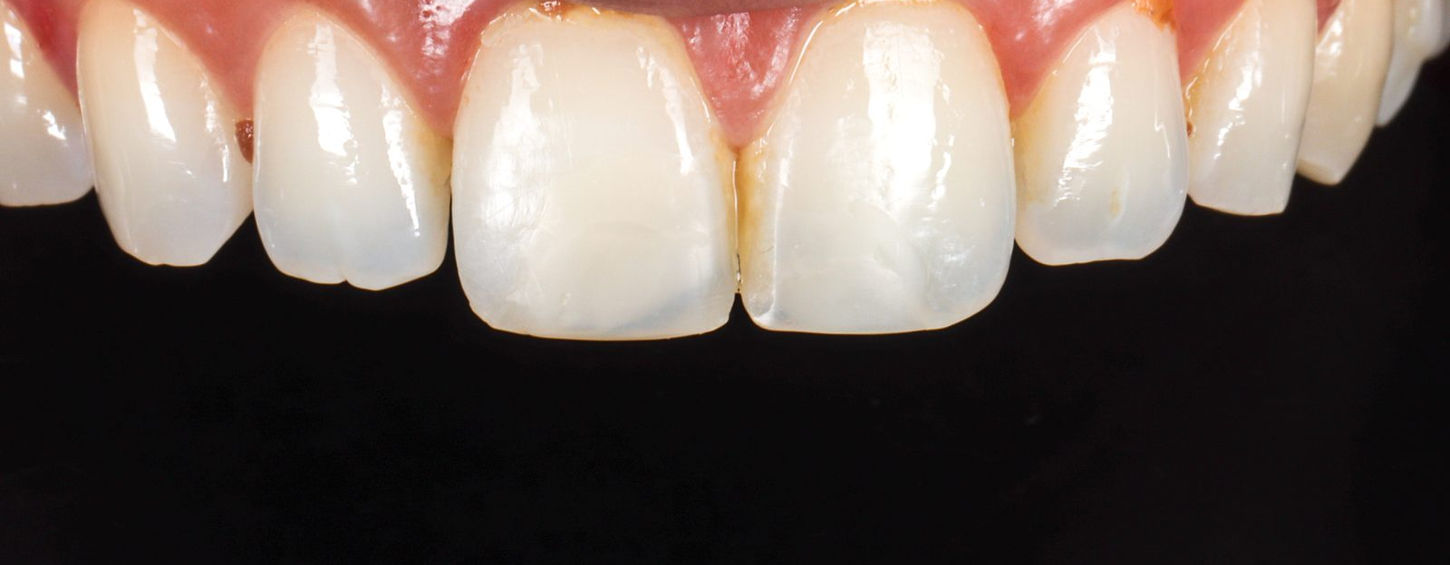 Before: the two upper central incisors bonded together closing the natural midline gap, with staining along the older bonding.