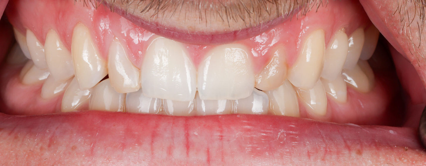 Small lateral incisor composite veneer treatment photo in Maspeth Queens