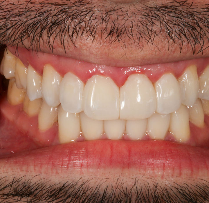 Bioclear bonding case image showing conservative closure of front-tooth spaces