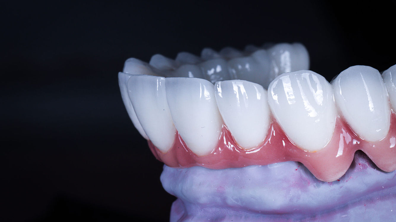 All-on-X full arch implant rehabilitation case photo at SOL Dental Arts in Maspeth Queens