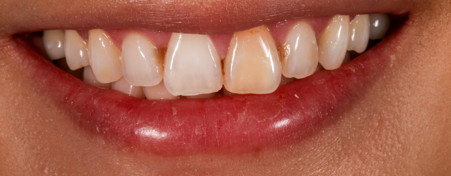 Close-up before indirect veneer treatment for a dark front tooth