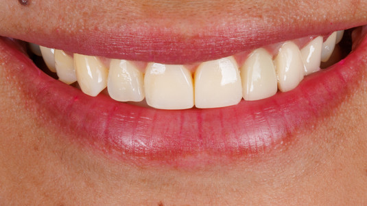 Veneers and whitening smile refinement at SOL Dental Arts, Maspeth Queens — case photo 8