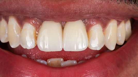 Implant crown replacing a missing tooth at SOL Dental Arts, Maspeth Queens — case photo 8