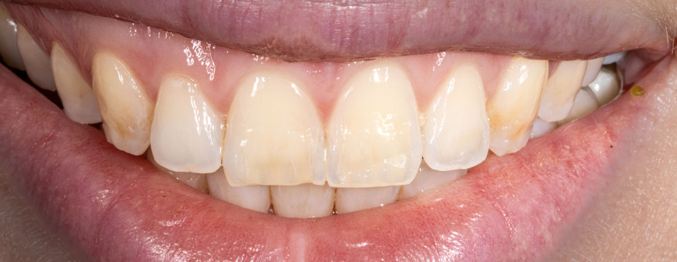 Indirect veneer for a single discolored tooth at SOL Dental Arts, Maspeth Queens — case photo 2