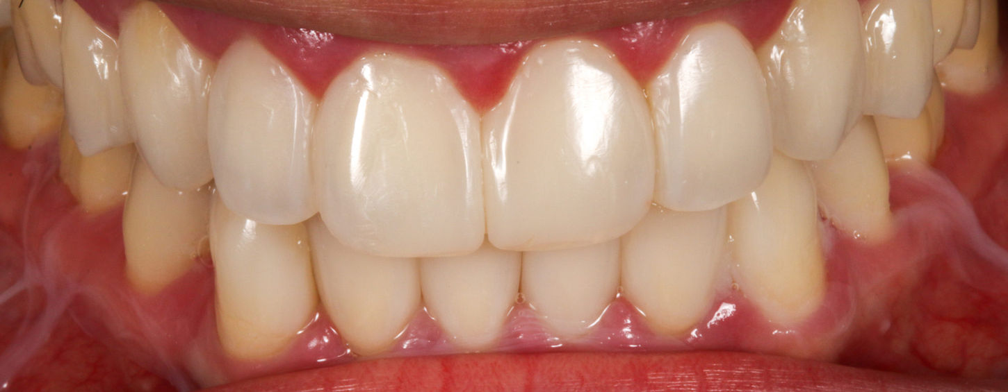 Close-up follow-up of conservative composite space closure between front teeth