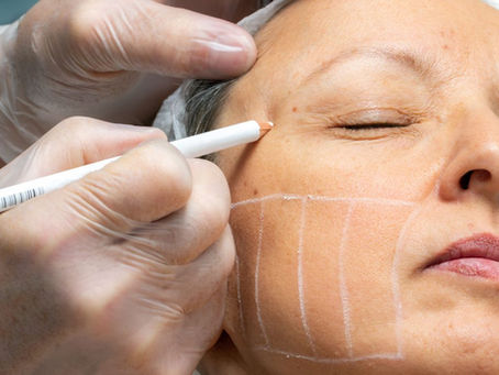 Is HIFU an Affordable Anti-Aging Solution?
