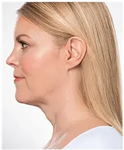 Kybella after photo of female chin and neck