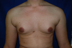 Gynecomasti 010  avant 