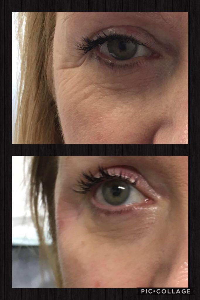 tear trough filler