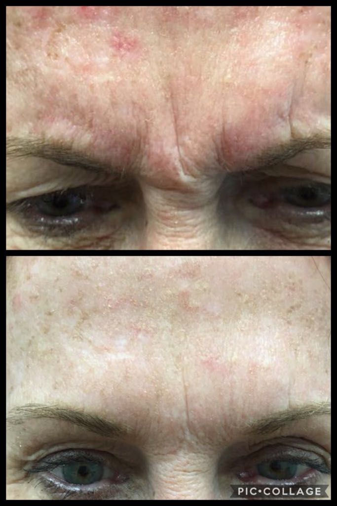 frowns antiwrinkles