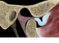Open view abnormal disc position TMJ