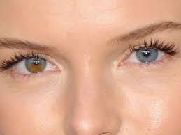 Heterocromia