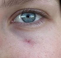 Aranya Capilar Ull Abans