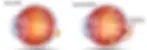 Presión intraocular glaucoma