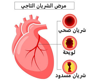 مرض الشريان التاجي
