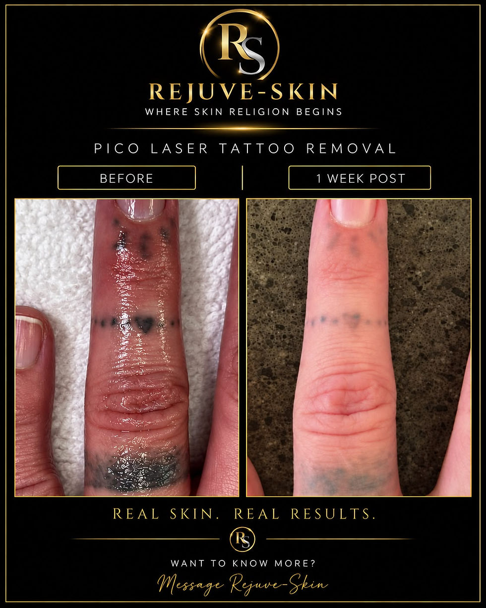 Tattoo removal
