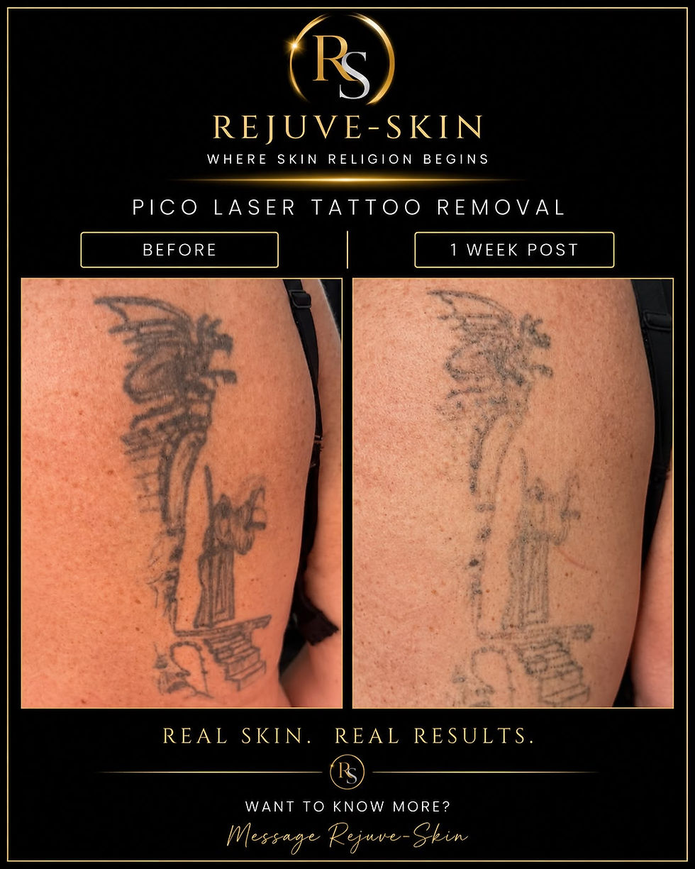 Tattoo removal