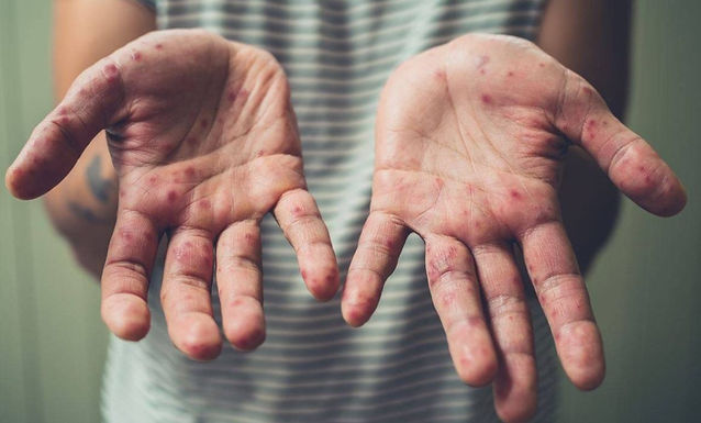 Suman 3 casos más de sarampión en Querétaro