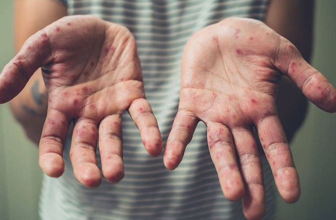 Suman 3 casos más de sarampión en Querétaro