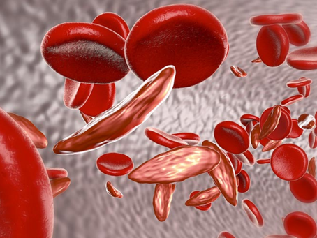 Sickle Cell Anaemia: Understanding a Genetic Blood Disorder