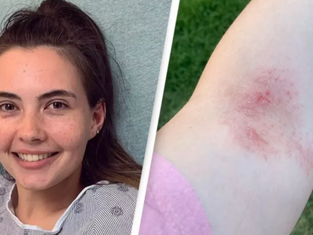 Exploring Aquagenetic Urticaria - The 'Water Allergy'