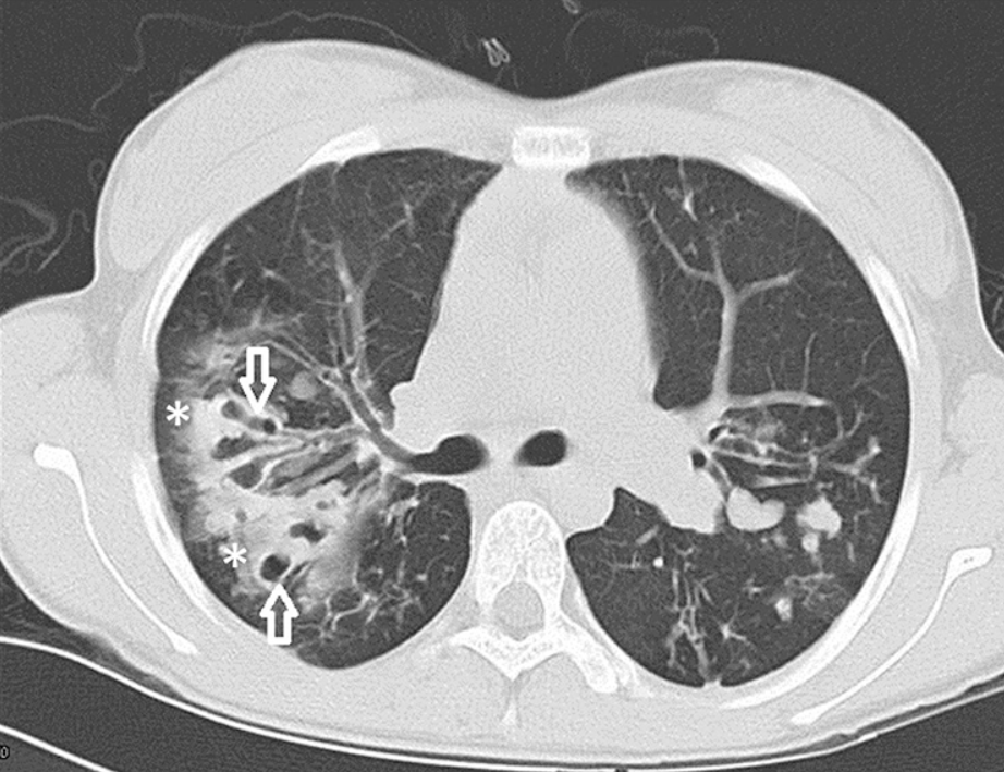 Reprinted from: Paranjape SM, Mogayzel PJ. Cystic fibrosis. Pediatr Rev. 2014;35(5).