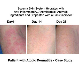 Eczema 24_edited.jpg
