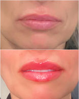 Lip filler before and after.jpeg