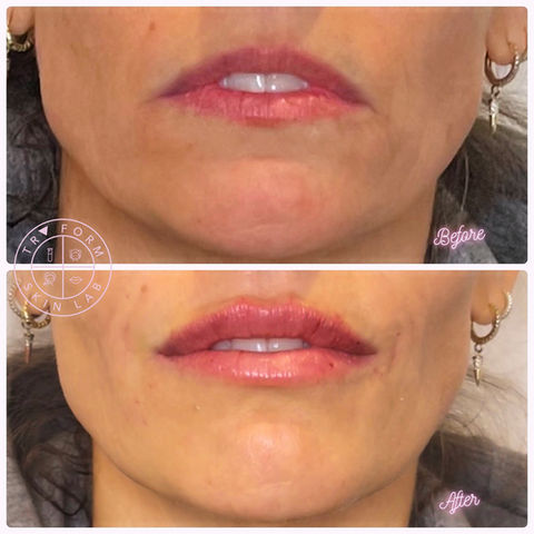 Lip filler before and after.jpeg