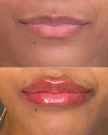 Lip filler before and after.jpeg
