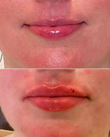 Lip filler before and after.jpeg