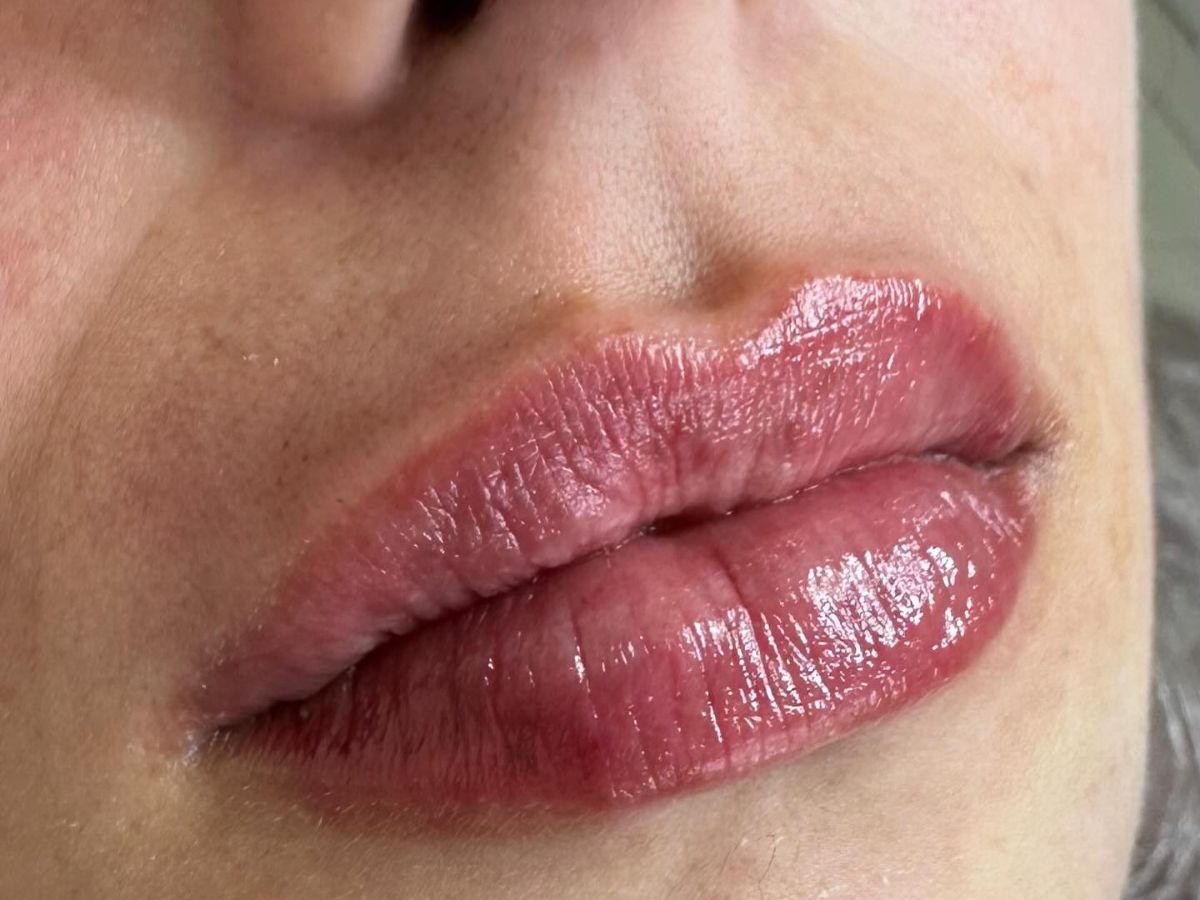 Preenchimento labial