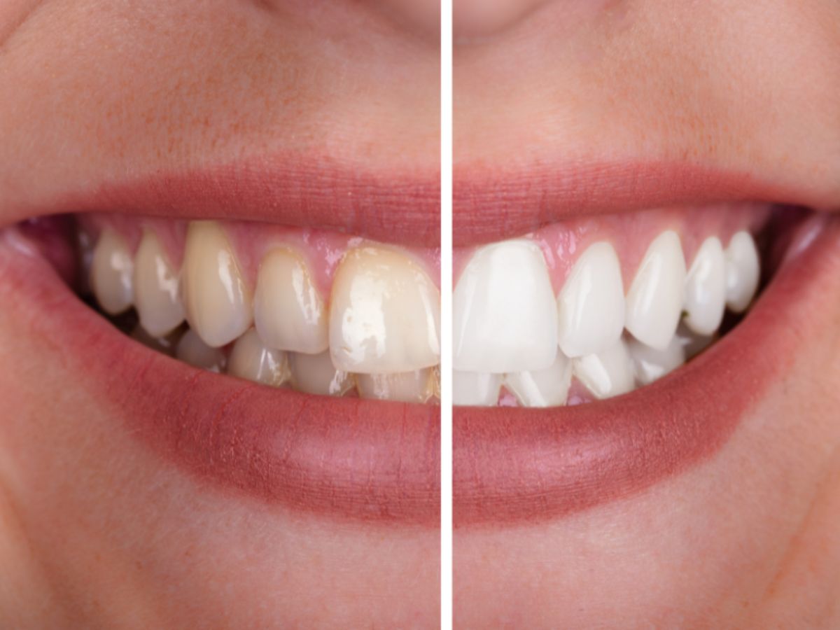 Clareamento dental