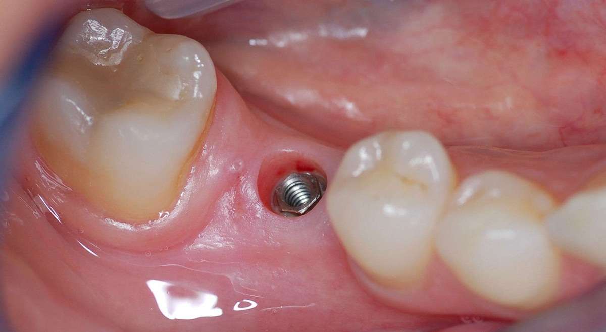 Implante dentário