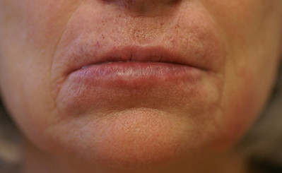 face injections stamford ct