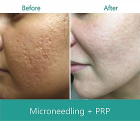 Microneedling Prp Acne Scars: Ultimate Treatment for Clear Skin