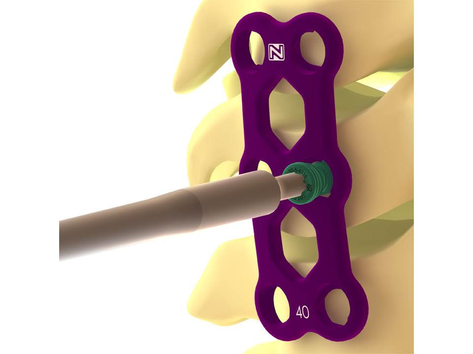 Blade® Anterior Cervical Plate