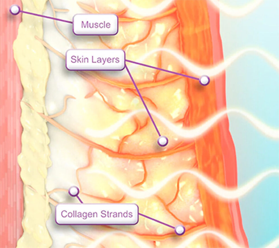 thermage-2-1024x912.jpg