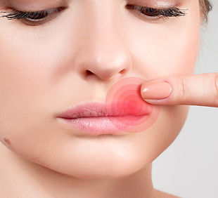 herpes_labial.jpg